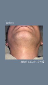 ひげ脱毛2回の変化|沖縄メンズ脱毛 2 DD2124BF D6A0 40BF 900B AA7371EA116A ひげ脱毛2回の変化|沖縄メンズ脱毛