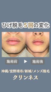 「え?何かしたの!?」から始まったメンズ脱毛|沖縄メンズ脱毛 6 00B12F5F A253 4668 83B1 0792AE3CAD7C 「え?何かしたの!?」から始まったメンズ脱毛|沖縄メンズ脱毛