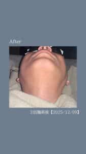 ひげ脱毛3回の変化|沖縄メンズ脱毛 3 0700AC20 3117 4F6A 988A 511A9C6FF2CC ひげ脱毛3回の変化|沖縄メンズ脱毛