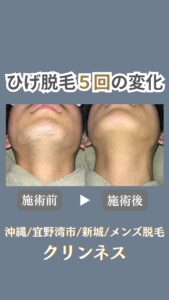 「え?何かしたの!?」から始まったメンズ脱毛|沖縄メンズ脱毛 5 7AFE75CF 122C 4771 8BA5 0AD3B255FDCC 「え?何かしたの!?」から始まったメンズ脱毛|沖縄メンズ脱毛