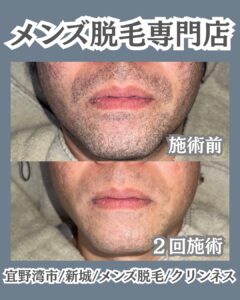 今から始めるメンズ脱毛・来年の成人式に向けて|沖縄メンズ脱毛 1 864AAD6A DAAD 493F 813E F9DE3B81A3E3 今から始めるメンズ脱毛・来年の成人式に向けて|沖縄メンズ脱毛