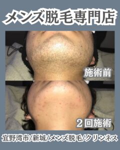 今から始めるメンズ脱毛・来年の成人式に向けて|沖縄メンズ脱毛 2 925AC86E 2138 4A43 B3BD 26F18DF81AE8 今から始めるメンズ脱毛・来年の成人式に向けて|沖縄メンズ脱毛