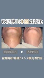 ひげ脱毛3回の変化|沖縄メンズ脱毛 1 E62A264B 24C7 4C51 BFB9 CC906C6EAF61 ひげ脱毛3回の変化|沖縄メンズ脱毛