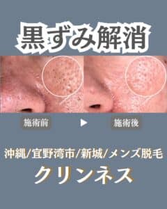 毛穴の黒ずみで悩んでいませんか?沖縄メンズ脱毛 1 D80592EB 64F2 4D04 B947 89891E080837 毛穴の黒ずみで悩んでいませんか?沖縄メンズ脱毛