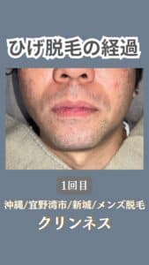 ひげ脱毛経過|沖縄メンズ脱毛 2 0AA370F1 B929 4A40 9239 483D6409EC04 ひげ脱毛経過|沖縄メンズ脱毛