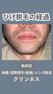 ひげ脱毛経過|沖縄メンズ脱毛 1 36241FB4 1117 40E8 BDD0 6D8A963DD4F4 ひげ脱毛経過|沖縄メンズ脱毛