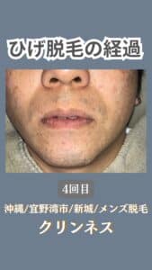ひげ脱毛経過|沖縄メンズ脱毛 5 5F1D03CA 28FF 4DDB 8ABC 48246A269264 ひげ脱毛経過|沖縄メンズ脱毛