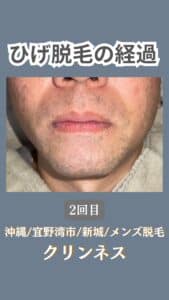 ひげ脱毛経過|沖縄メンズ脱毛 3 61230476 755D 4189 8361 124CF0DC7052 ひげ脱毛経過|沖縄メンズ脱毛