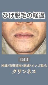 ひげ脱毛経過|沖縄メンズ脱毛 4 66679FFC 185C 497E 9550 E27EE962333E ひげ脱毛経過|沖縄メンズ脱毛