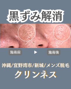 毛穴洗浄こんな方にピッタリ!沖縄メンズ脱毛 1 A5C4F1E4 8975 492A AE34 B15B5EC80E62 毛穴洗浄こんな方にピッタリ!沖縄メンズ脱毛