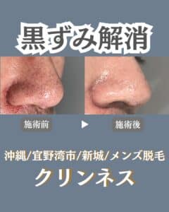 直後から変化を実感!毛穴洗浄!沖縄メンズ脱毛 2 B01125A5 69E7 41F0 90FE DF84614DFB43 直後から変化を実感!毛穴洗浄!沖縄メンズ脱毛