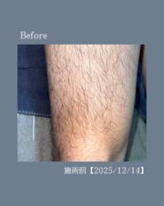 短パンの似合う足へ!沖縄メンズ脱毛 2 150247C2 DC48 46CA AFCC 4EE5A60AF81E 短パンの似合う足へ!沖縄メンズ脱毛