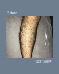 悩みを自信に変える!沖縄メンズ脱毛 2 4218D2BF 9605 44C4 9F4E E8B7014676AF 悩みを自信に変える!沖縄メンズ脱毛