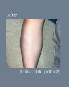 悩みを自信に変える!沖縄メンズ脱毛 3 994911CE 0558 48A1 AC2F 482B41058186 悩みを自信に変える!沖縄メンズ脱毛