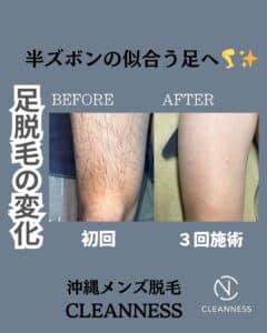 短パンの似合う足へ!沖縄メンズ脱毛 1 B5E56765 1E34 4711 98D3 6E83CB16DE78 短パンの似合う足へ!沖縄メンズ脱毛