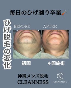 毎日のひげ剃り卒業!沖縄メンズ脱毛 1 B6EF3D1A 199B 409F AECD 12AB8BE55D7E 毎日のひげ剃り卒業!沖縄メンズ脱毛