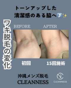 061EC429 42A1 4C55 9921 94F8758337FD 清潔感のあるワキへ！沖縄メンズ脱毛