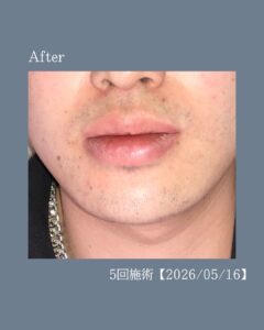 4783D656 2687 4B1F 819A 0576536BAD15 ひげ脱毛5回の変化！沖縄メンズ脱毛