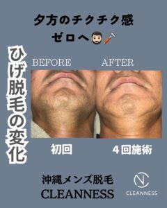 夕方のチクチク感ゼロへ!沖縄メンズ脱毛 1 4AC0733C 4203 4B92 8123 5B813B854DD2 夕方のチクチク感ゼロへ!沖縄メンズ脱毛