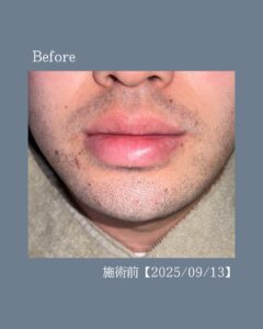 58B15C6E AD0D 434B 95BC B825322413C5 ひげ脱毛5回の変化！沖縄メンズ脱毛
