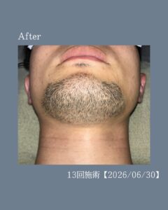 ひげ脱毛の変化!沖縄メンズ脱毛 3 7297B399 864A 4381 A730 2FBA86481C5C ひげ脱毛の変化!沖縄メンズ脱毛