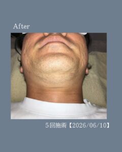 脱毛でひげを整える!沖縄メンズ脱毛 3 9BC391C2 4539 4542 B865 6BEAF97BD66F 脱毛でひげを整える!沖縄メンズ脱毛