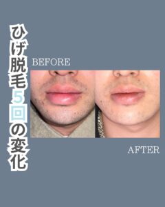 9CB05646 B3B1 48B3 A0AE D6578698A313 ひげ脱毛5回の変化！沖縄メンズ脱毛