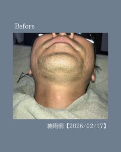 脱毛でひげを整える!沖縄メンズ脱毛 2 A87C1185 7DD5 4BD6 85AD D4BB7F309A9C 脱毛でひげを整える!沖縄メンズ脱毛