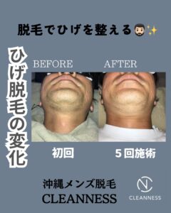 脱毛でひげを整える!沖縄メンズ脱毛 1 AA24405C B8E2 41DB B85D 2D99A9B5C5BE 脱毛でひげを整える!沖縄メンズ脱毛