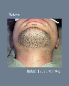 ひげ脱毛の変化!沖縄メンズ脱毛 2 C55A2292 DBD6 4A79 B091 36439EED8531 ひげ脱毛の変化!沖縄メンズ脱毛