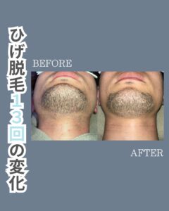 ひげ脱毛の変化!沖縄メンズ脱毛 1 CC6DA63A 8913 4FF5 B3B7 BC334B616624 ひげ脱毛の変化!沖縄メンズ脱毛