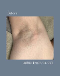 FD7197B2 B7E0 4A84 B09C F40B2B1EA693 清潔感のあるワキへ！沖縄メンズ脱毛