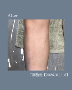 脚脱毛の変化!沖縄メンズ脱毛 3 0A9881B0 EC62 453B 86C7 D6675C3D67B0 脚脱毛の変化!沖縄メンズ脱毛