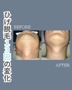 ひげ脱毛13回の変化!沖縄メンズ脱毛 1 4E196E61 7549 4633 AF32 AE549D0E8AD8 ひげ脱毛13回の変化!沖縄メンズ脱毛