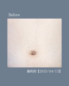 チクチクお腹から卒業!沖縄メンズ脱毛 2 4F7518FE DF9D 4D2E 87A7 038D6A77E549 チクチクお腹から卒業!沖縄メンズ脱毛
