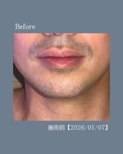 青ひげか消えた!沖縄メンズ脱毛 2 63F94220 73CC 450E B36F 36F233D7BE90 青ひげか消えた!沖縄メンズ脱毛