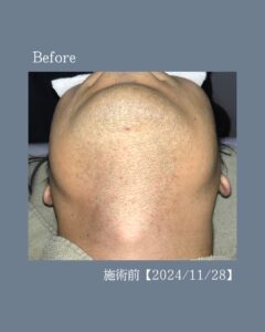 ひげ脱毛13回の変化!沖縄メンズ脱毛 2 66683468 8017 42E5 AD5F 7B3990C18199 ひげ脱毛13回の変化!沖縄メンズ脱毛