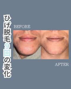 ひげ脱毛9回の変化!沖縄メンズ脱毛 1 72692EF8 6FEC 4956 8DDE 592DF9B6B5F9 ひげ脱毛9回の変化!沖縄メンズ脱毛