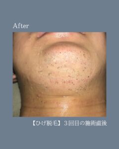 ひげがその場で抜ける!沖縄メンズ脱毛 3 7B5D0D44 E9E9 4AE0 8548 6C84654ABB6C ひげがその場で抜ける!沖縄メンズ脱毛