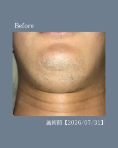 ひげがその場で抜ける!沖縄メンズ脱毛 2 86EF40D3 EF24 49D7 AB1F 22A24D80E037 ひげがその場で抜ける!沖縄メンズ脱毛