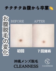 チクチクお腹から卒業!沖縄メンズ脱毛 1 929891DF 4BE0 4366 94EF 43A87B40B58C チクチクお腹から卒業!沖縄メンズ脱毛