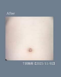 チクチクお腹から卒業!沖縄メンズ脱毛 3 99A77F9E 9001 46AB BD49 F6229DFF8EB4 チクチクお腹から卒業!沖縄メンズ脱毛
