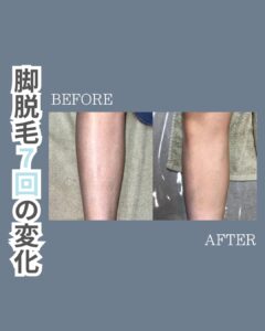脚脱毛の変化!沖縄メンズ脱毛 1 9A80D60A 155F 40E3 BB03 BFF0D981A97D 脚脱毛の変化!沖縄メンズ脱毛