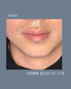 青ひげか消えた!沖縄メンズ脱毛 3 B1F605F5 F446 452F 920D 424916FD733C 青ひげか消えた!沖縄メンズ脱毛