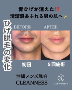 青ひげか消えた!沖縄メンズ脱毛 1 C743B431 AB72 4A31 B999 AA9EB01205D6 青ひげか消えた!沖縄メンズ脱毛