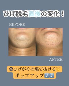 ひげがその場で抜ける!沖縄メンズ脱毛 1 CA16BB2B 9411 49B8 9705 7ACB6138D2BD ひげがその場で抜ける!沖縄メンズ脱毛