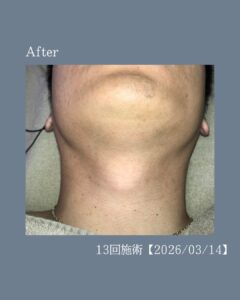 ひげ脱毛13回の変化!沖縄メンズ脱毛 3 CB977882 8EBA 466C 87D3 5DF547873E5C ひげ脱毛13回の変化!沖縄メンズ脱毛
