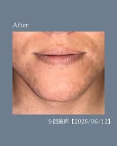 ひげ脱毛9回の変化!沖縄メンズ脱毛 3 E67E27DF D93B 484E 8DD9 A77EA3DEE9CD ひげ脱毛9回の変化!沖縄メンズ脱毛