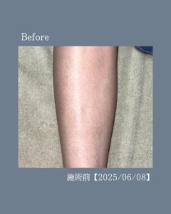 脚脱毛の変化!沖縄メンズ脱毛 2 EB346F22 1565 4361 ADB8 CCF0D2219666 脚脱毛の変化!沖縄メンズ脱毛