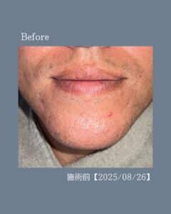 ひげ脱毛9回の変化!沖縄メンズ脱毛 2 EB9C8896 4450 4A6E 9FDE 8D3F8EC74120 ひげ脱毛9回の変化!沖縄メンズ脱毛